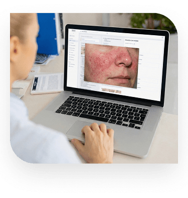 Side profile of young woman showing severe acne rosacea skin condition mobile