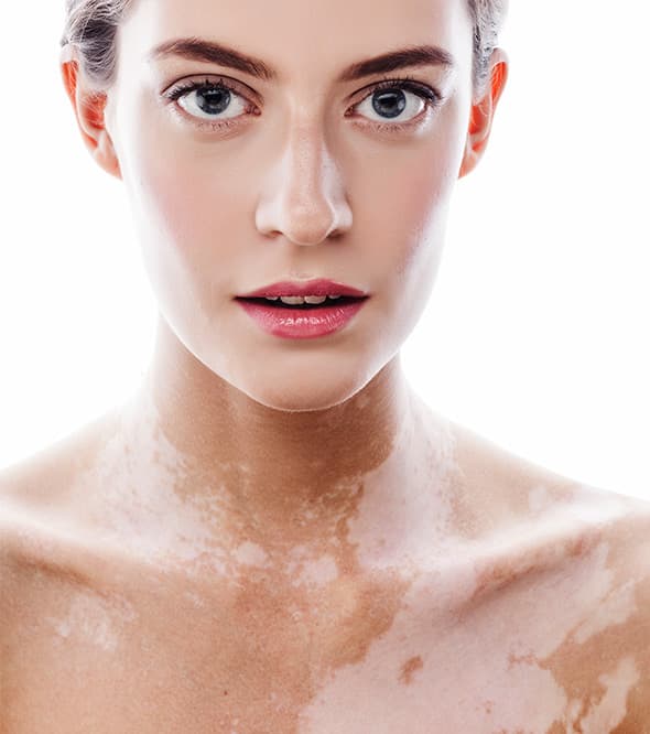 Pale depigmented patches on a woman's neck and chest, characteristic of vitiligo.