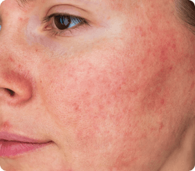 Close-up of diffuse skin redness and flushing on a cheek. title.erythematous.pink