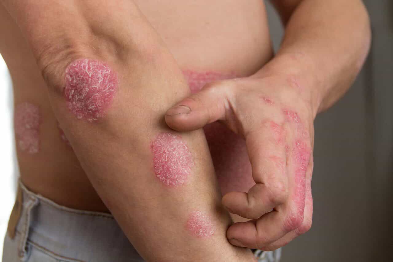 Psoriazė ant alkūnės: ryškios raudonos dėmės, dengtos sidabriniais žvyneliais, su aiškiais kraštais